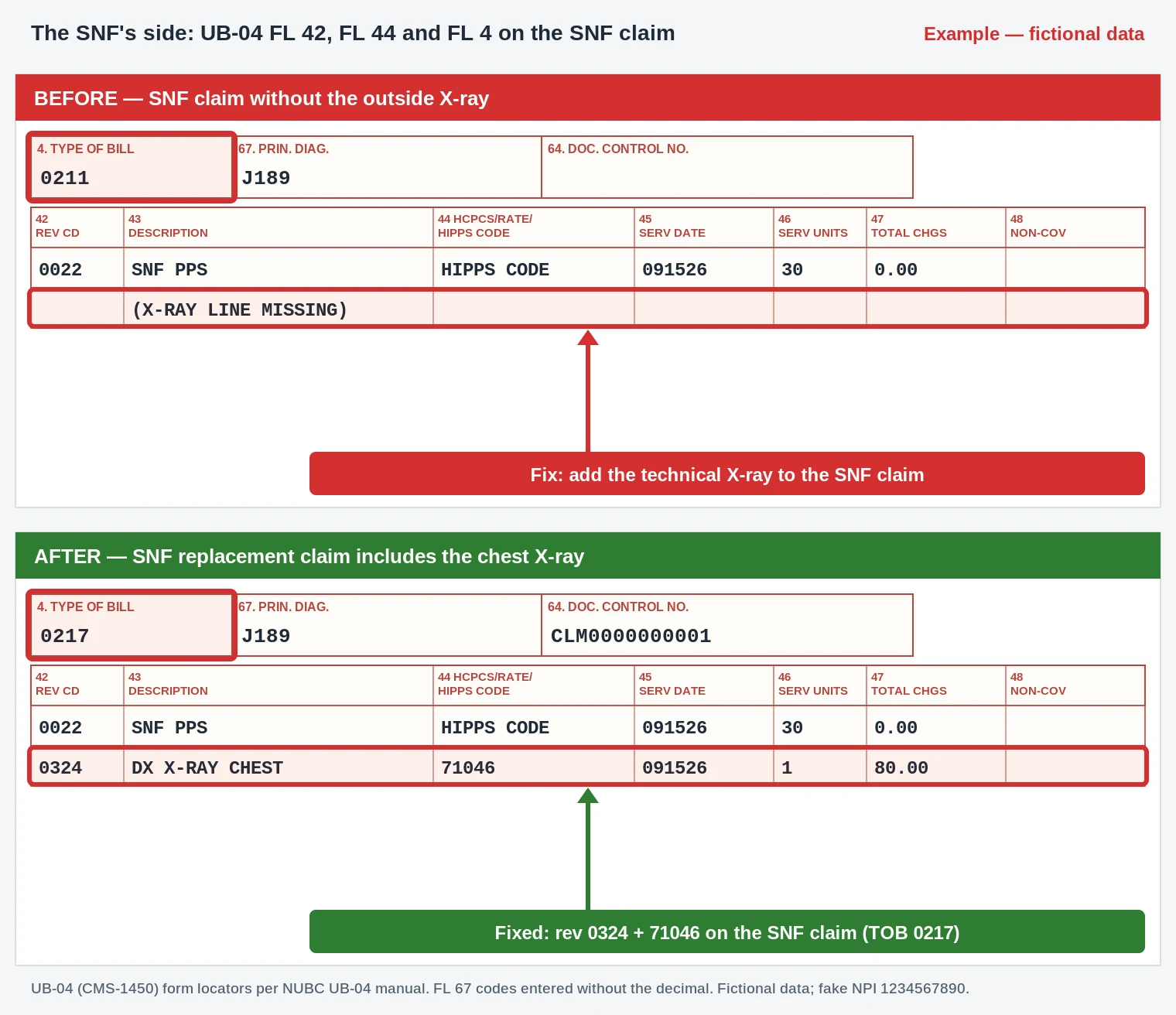 CO-190 Denial Code (CARC 190) 2026: Payment Included in the SNF Qualified Stay 4 CO-190 UB-04 skilled nursing claim adding revenue code 0324 with 71046 for the chest X-ray